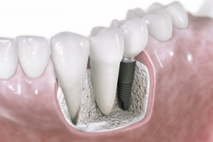 Современные тенденции в имплантации зубов