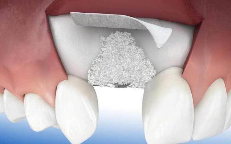 Конструкция зубных имплантатов