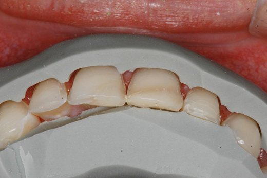 Слепок зубного ряда