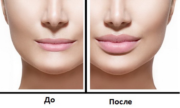 Различные виды увеличения губ