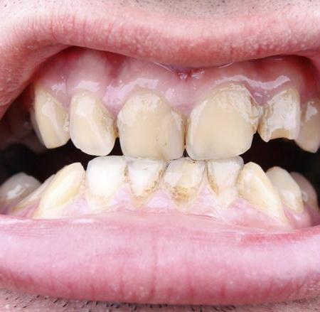 Зубная нить предотвращает образование зубного камня