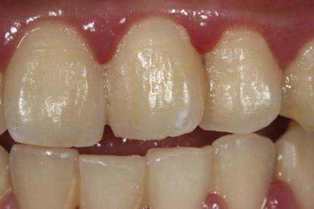 Зубная нить предотвращает обесцвечивание зубов