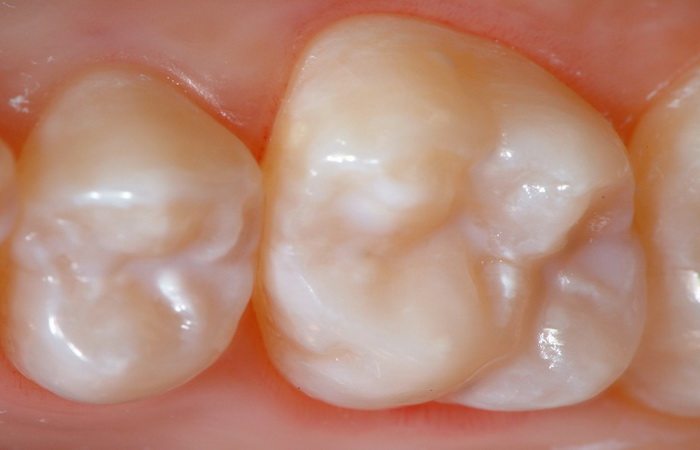 зубные герметики